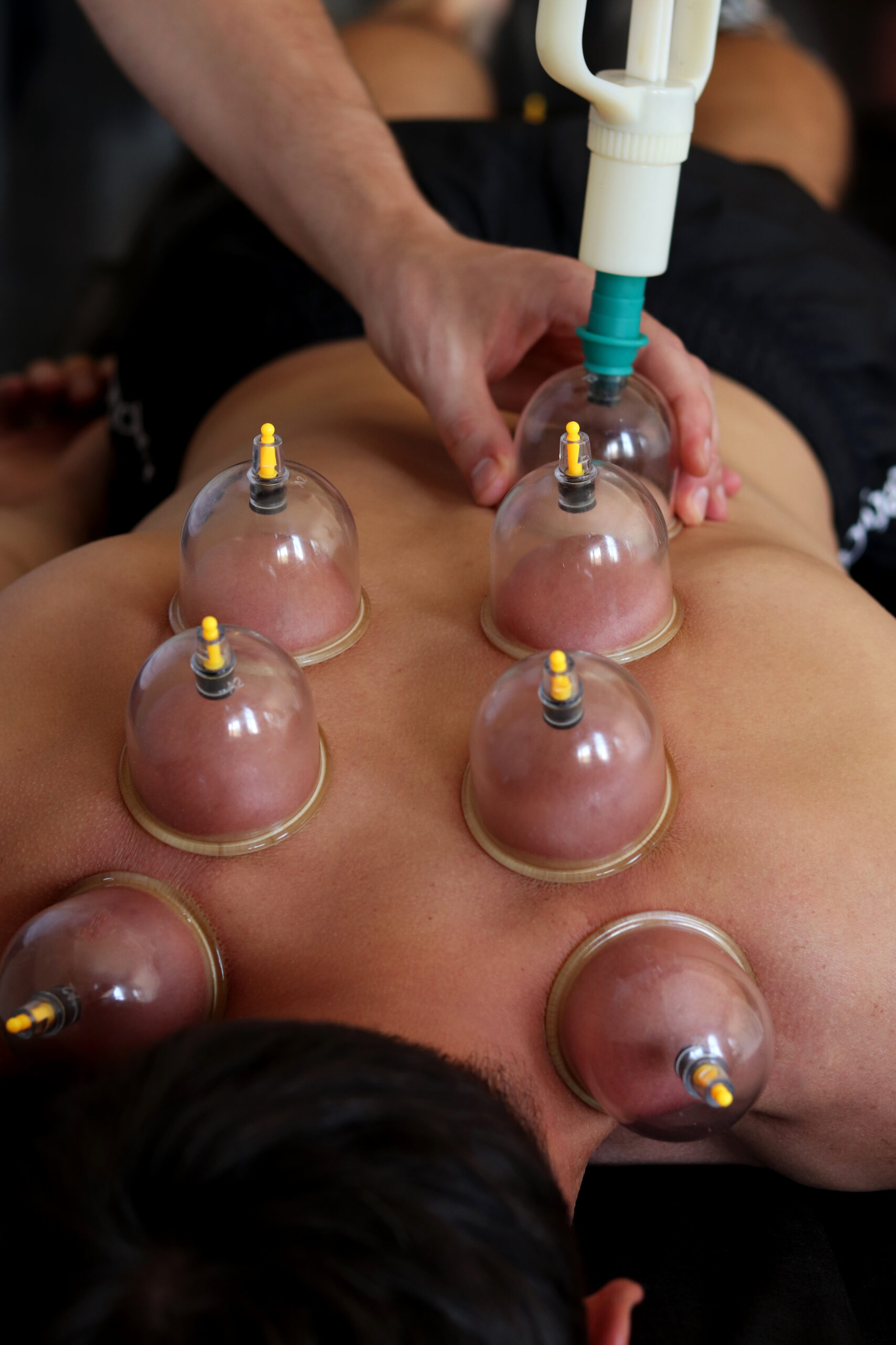 Cupping therapy applied to back muscles during in-home physical therapy session