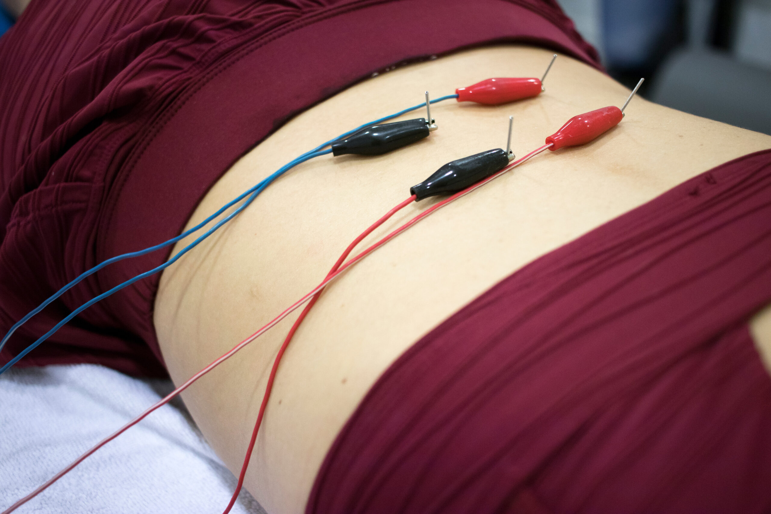 Dry needling treatment performed by physical therapist to reduce muscle tension