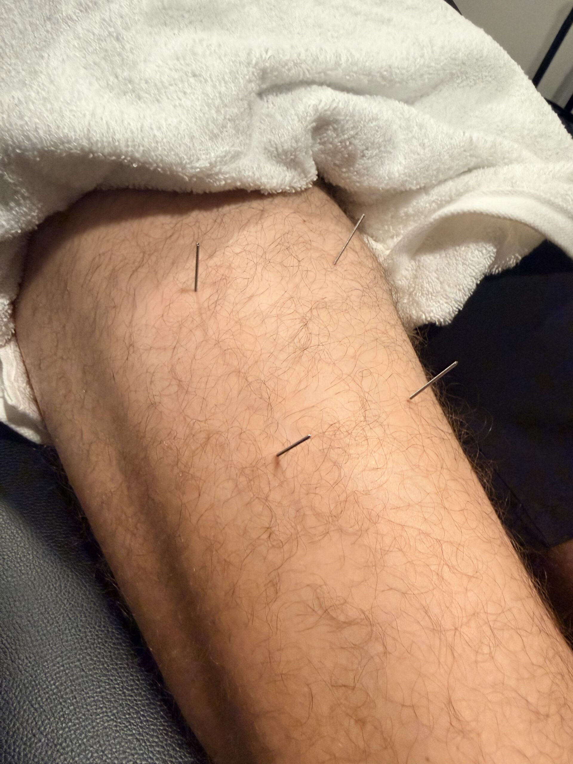 Dry needling treatment performed by physical therapist to reduce muscle tension