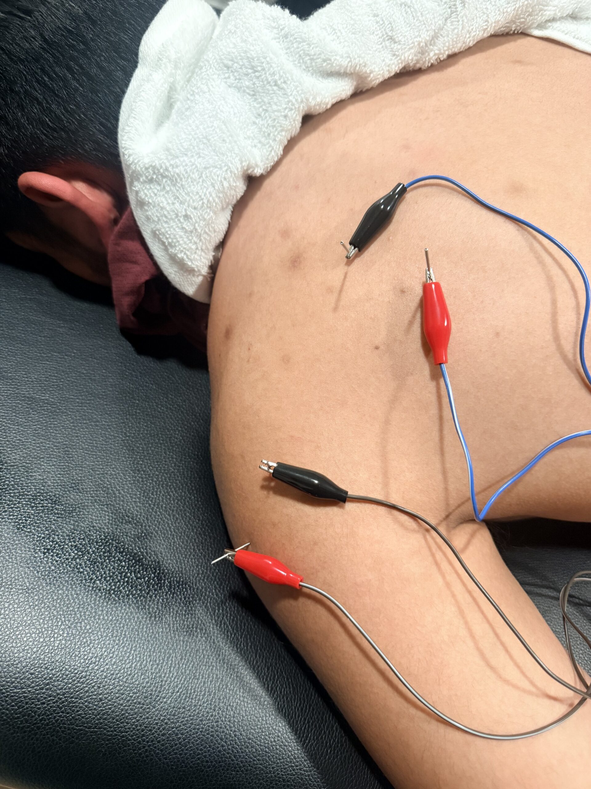 Dry needling treatment performed by physical therapist to reduce muscle tension