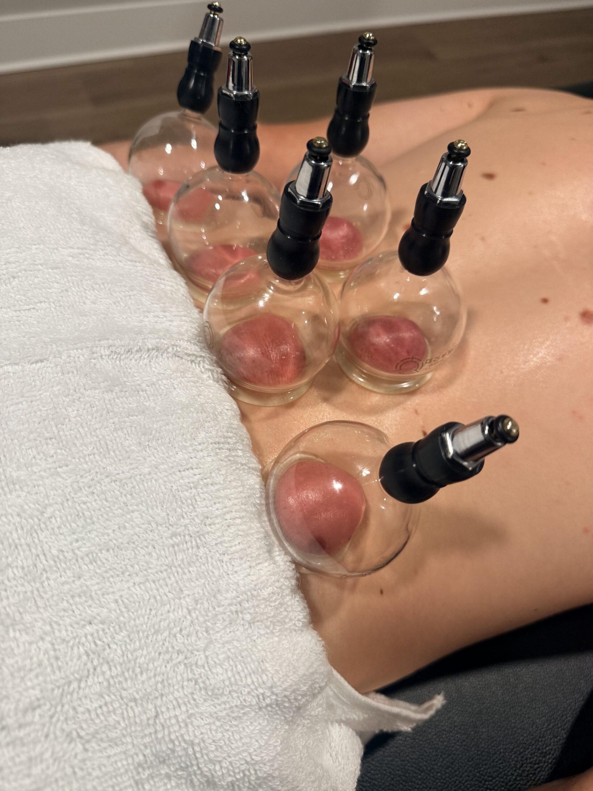 Cupping therapy applied to back muscles during in-home physical therapy session